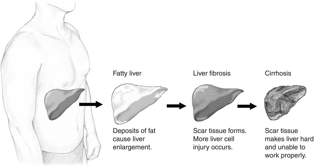 Non-alcoholic Fatty Liver Disease